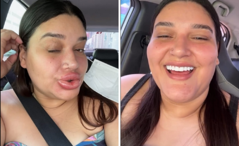 apos-maquiadora-ficar-com-labios-gigantes,-medica-fala-sobre-cuidados-com-procedimentos-esteticos