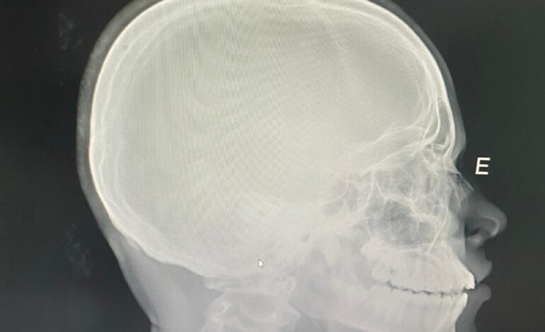 estudante-tem-nariz quebrado em-escola-publica-do-tocantins-e-familia-denuncia-ofensas-racistas